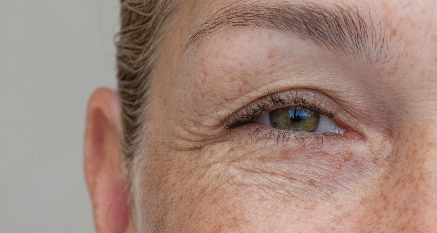 Heilungsprozess Unterlidstraffung, Dr. Deb, Central Aesthetics, Plastische Chirurgie & Schönheitschirurgie in Frankfurt