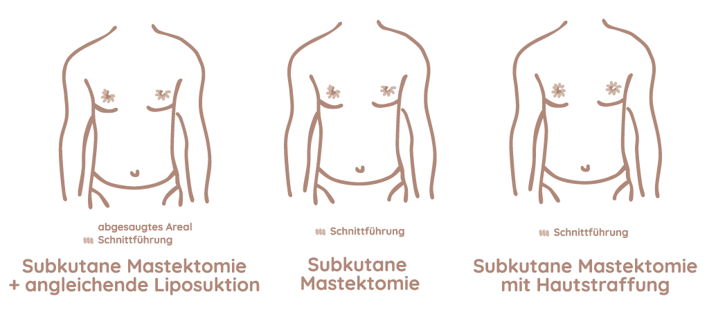 Gynäkomastie Grafik Frankfurt