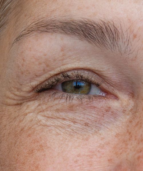 Augenlidstraffung in Nahaufnahme