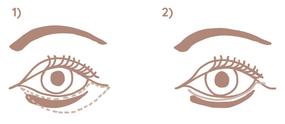 Unterlidstraffung Grafik Frankfurt